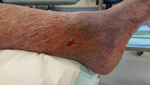 This small but painful wound has been present for two years. Wounds like this can often be healed in weeks with appropriate care.